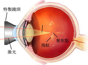 惠州眼科医院：“蚊子”飞进眼睛里会瞎？