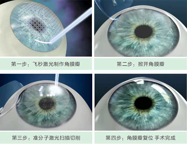 全飞秒,技术,升级,切口,更小,更,安全,眼睛,是, 全飞秒,技术,升级,切口,更小,更,安全,眼睛,是,