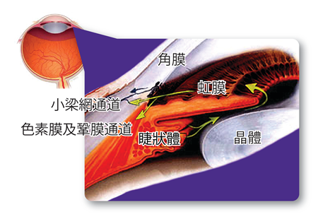 青光眼,青光眼治疗,慢性青光眼,青光眼治疗