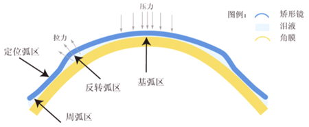 近视,配镜,近视加深,角膜塑形镜,ok镜