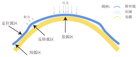 近视,眼镜,度数加深,近视加深,角膜塑形镜