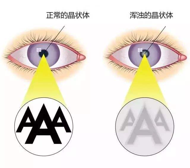 晶状体图示