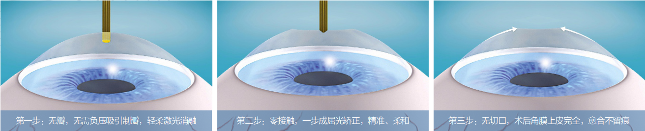 近视手术,激光矫正,晶体植入式,惠州希玛眼科医