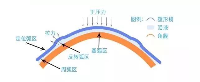 青少年近视,儿童近视,OK镜,惠州希玛眼科医院