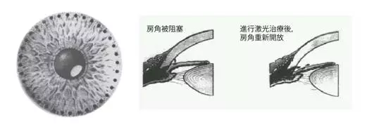 干眼症,急性青光眼,眼中风,惠州希玛眼科医院