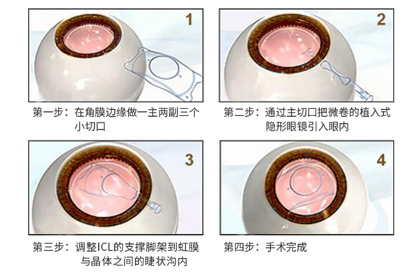 近视,治疗近视，近视手术，惠州希玛眼科医院