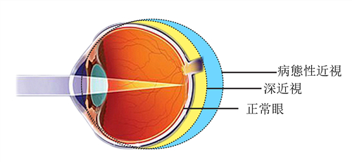 高度近视,屈光,近视,惠州希玛眼科