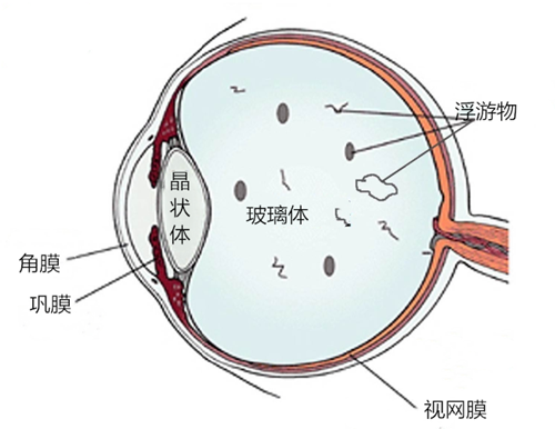 飞蚊,病症,玻璃体,视网膜,惠州希玛眼科医院