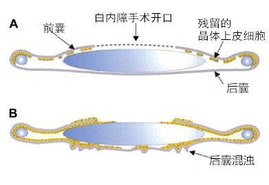 白内障,人力,出現,白内障手术,手术治疗