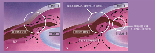 白内障,黄斑转性,青光眼,惠州希玛眼科医院