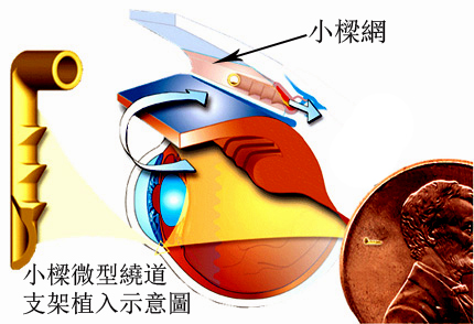 青光眼,失明性眼睛疾病,惠州希玛眼科