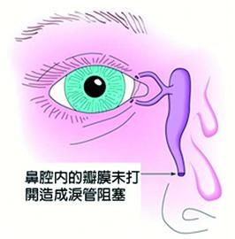 视网膜,视网膜动脉阻塞,眼中风,惠州希玛眼科