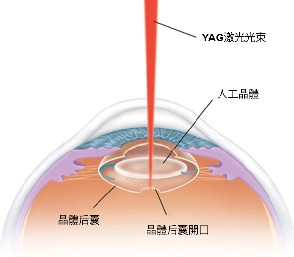 白内障,白内障手术,惠州希玛眼科医院