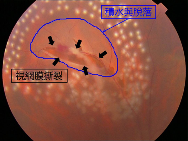 飞蚊症,惠州治疗飞蚊症,惠州希玛眼科医院