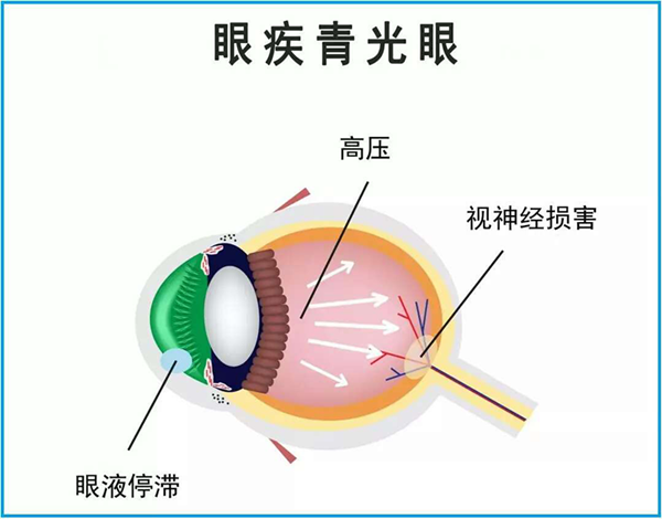 青光眼,惠州治疗青光眼,惠州希玛眼科医院