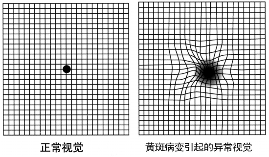 黄斑变性,黄斑变性,老年黄斑变性,惠州希玛眼科