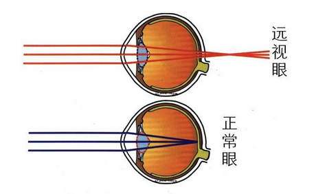 散光,散光测试,惠州希玛眼科医院