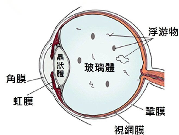 飞蚊症,玻璃体浑浊,飞蚊症治疗,惠州希玛眼科医院