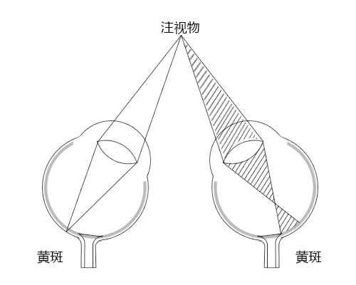 弱视,小儿弱视,治疗弱视,惠州希玛眼科医院