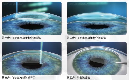 飞秒激光和准分子激光的区别