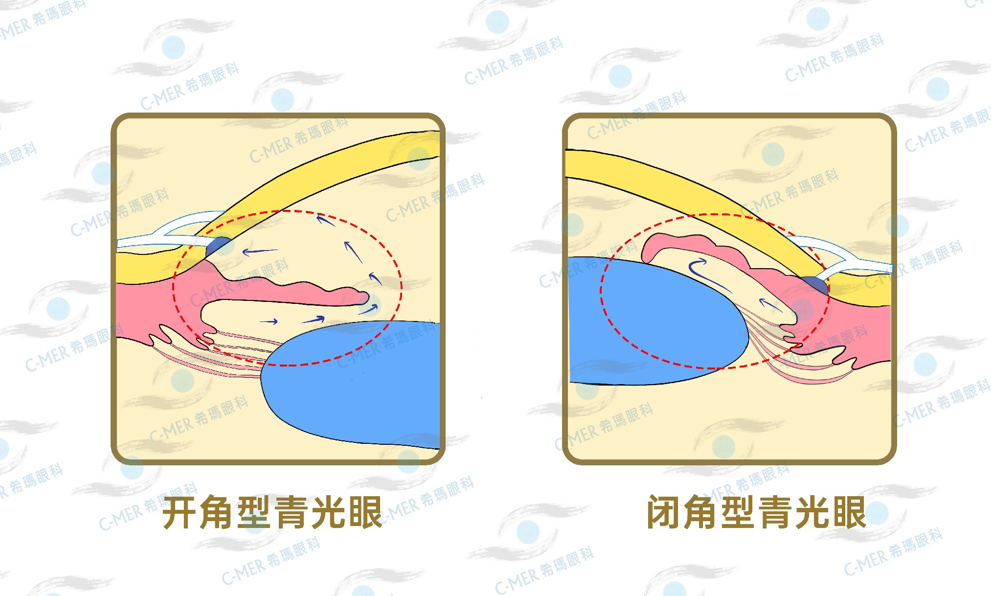 开角型青光眼及闭角型青光眼