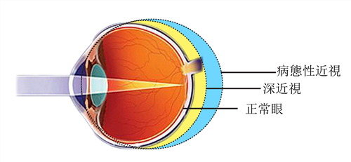 视网膜脱落,高度近视,近视手术,惠州希玛林顺潮