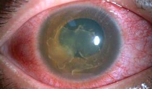 葡萄膜炎,红眼病,视力下降,惠州希玛眼科医院