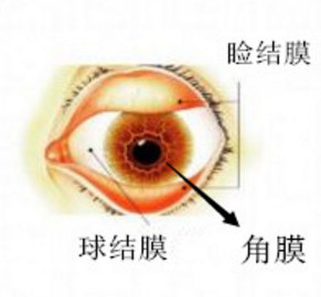 角膜炎,角膜鳞状,角膜穿孔,惠州希玛眼科医院