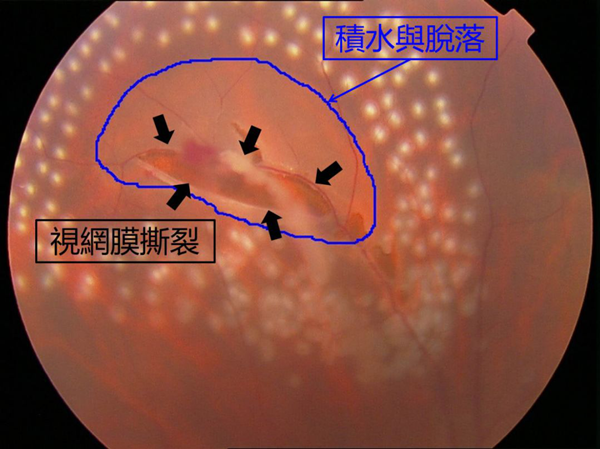 飞蚊症,玻璃体浑浊,视网膜脱落,惠州希玛眼科医