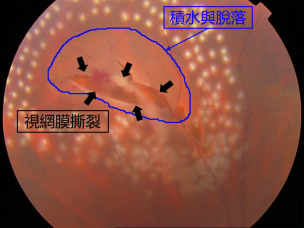 视网膜脱落,视网膜撕裂,近视手术,惠州希玛林顺潮眼科医院
